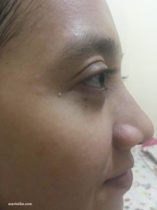 azariatika setelah pemakaian himalaya herbals neem mask 225x300 - azariatika_setelah_pemakaian_himalaya_herbals_neem_mask