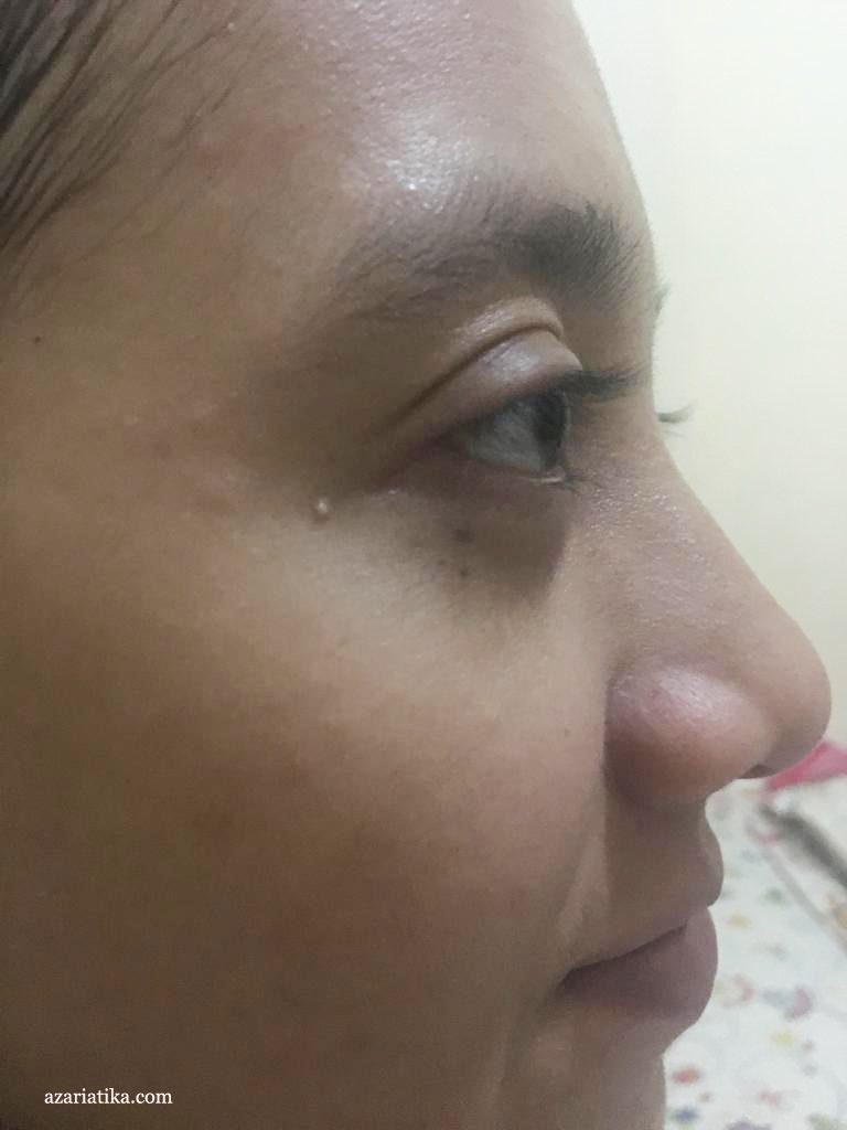 Review Masker Himalaya Purifying Neem Mask, Penolong Kulit Bruntusan dan Jerawatan azariatika setelah pemakaian himalaya herbals neem mask 768x1024 - Review Masker Himalaya Purifying Neem Mask, Penolong Kulit Bruntusan dan Jerawatan